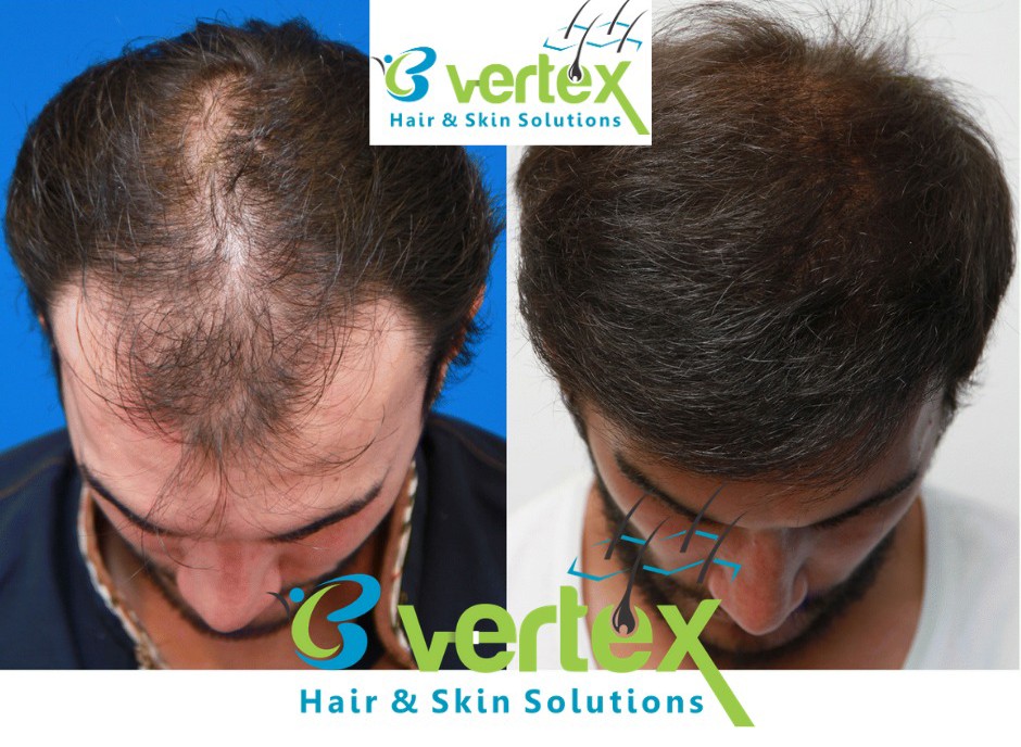 hair transplant clinic in west delhi