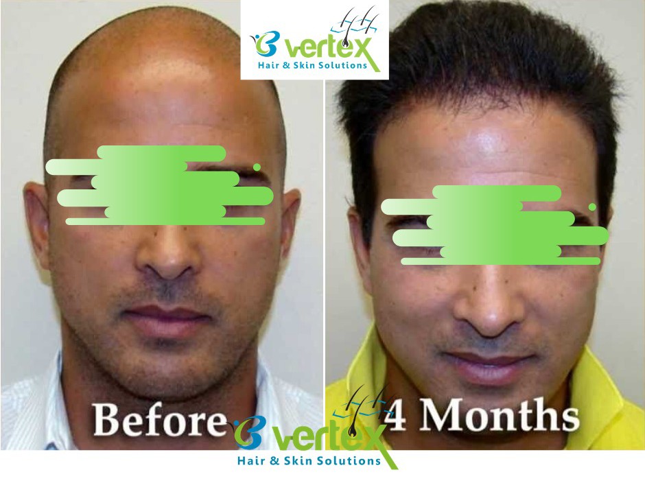 best hair transplant in ghaziabad